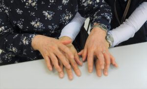 盲ろうの闇を救った「指点字」とは? 技術革新が開いた扉